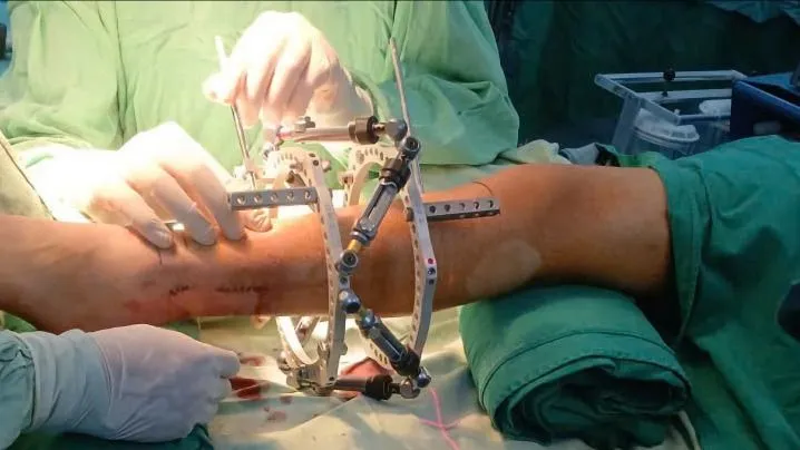 Phẫu thuật kéo chân cho thiếu niên có 2 chân lệch nhau 7cm