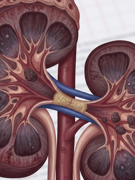 Dấu hiệu trong máu cảnh báo thận đang gặp vấn đề