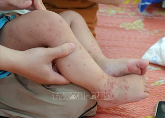 Tăng cường phòng dịch, hạn chế bệnh chuyển nặng