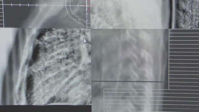 Kết hợp hóa xạ trị tiêu diệt khối u phổi ở người đàn ông hút thuốc lào hơn 30 năm - Ảnh 2.