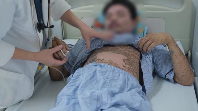 Nam thanh niên được cứu sống nhờ phát hiện sớm hội chứng hoại tử da hiếm gặp - Ảnh 1.