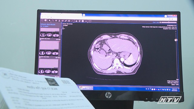 Trí tuệ nhân tạo mở ra hi vọng mới cho người bệnh ung thư gan - Ảnh 1.