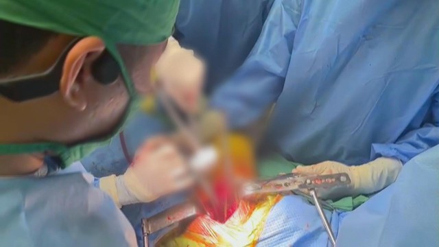 Liên tiếp thay khớp háng thành công cho người trẻ bị hoại tử chỏm xương đùi nặng - Ảnh 3.