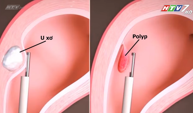 Nội soi buồng tử cung: Chìa khóa nâng cao hiệu quả IVF | Tập 7 - Sống khỏe cùng chuyên gia- Ảnh 5.