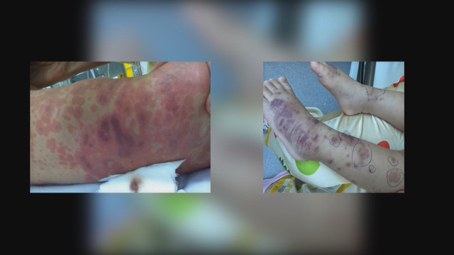 Chủ động phòng ngừa viêm não mô cầu trong mùa dịch- Ảnh 1. Chủ động phòng ngừa viêm não mô cầu trong mùa dịch- Ảnh 1.