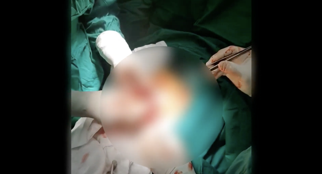 Thức khuya, ăn uống thất thường khiến chàng trai 17 tuổi thủng ổ loét môn vị tá tràng nguy kịch - Ảnh 2.