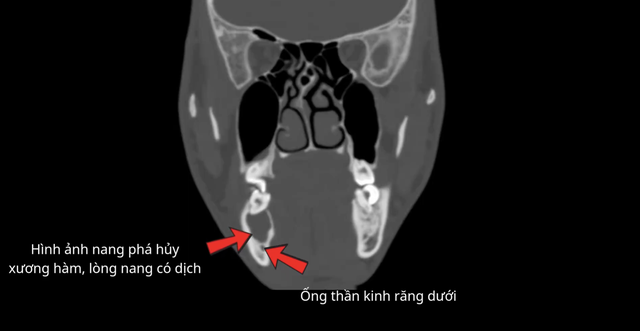 Chủ quan với răng sâu, thanh niên 25 tuổi phải cùng lúc nhổ bỏ 3 chiếc răng vì nang xương hàm - Ảnh 3.