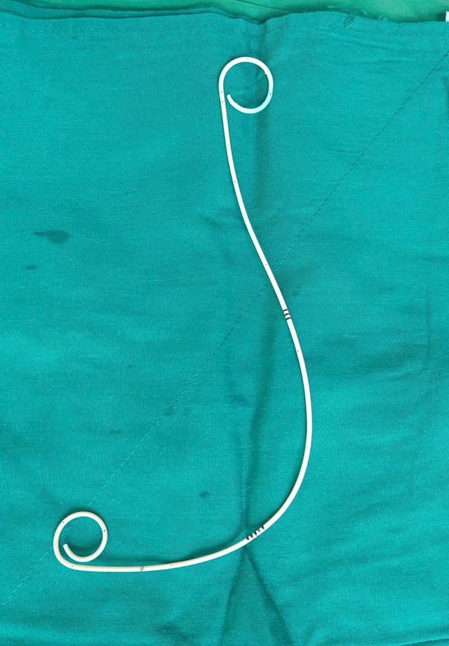 Biến chứng nguy hiểm vì để quên sonde JJ trong cơ thể - Ảnh 2.
