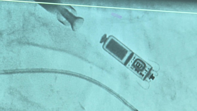 Đặt thành công máy tạo nhịp tim không dây hai buồng cứu sống cụ bà 83 tuổi- Ảnh 4. Đặt thành công máy tạo nhịp tim không dây hai buồng cứu sống cụ bà 83 tuổi- Ảnh 4.