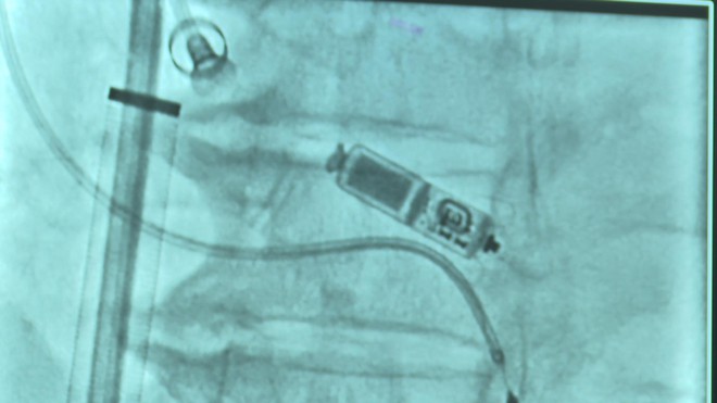 Đặt thành công máy tạo nhịp tim không dây hai buồng cứu sống cụ bà 83 tuổi- Ảnh 3. Đặt thành công máy tạo nhịp tim không dây hai buồng cứu sống cụ bà 83 tuổi- Ảnh 3.