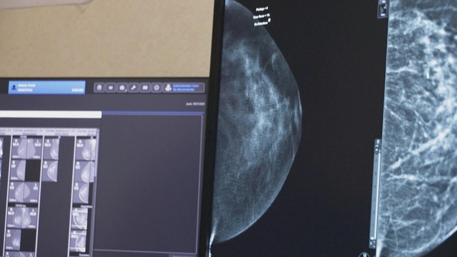 Thụy Điển nghiên cứu dùng A.I. cải thiện sàng lọc ung thư vú - Ảnh 2.