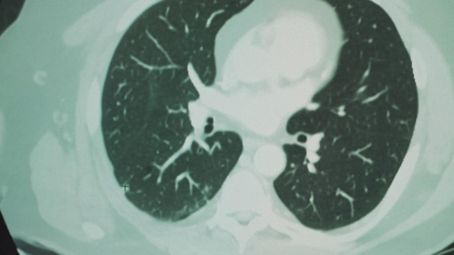 Thụy Điển nghiên cứu dùng A.I. cải thiện sàng lọc ung thư vú - Ảnh 4.