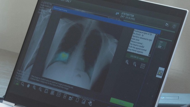 Philippines tích hợp trí tuệ nhân tạo nhận diện bệnh lao - Ảnh 1.