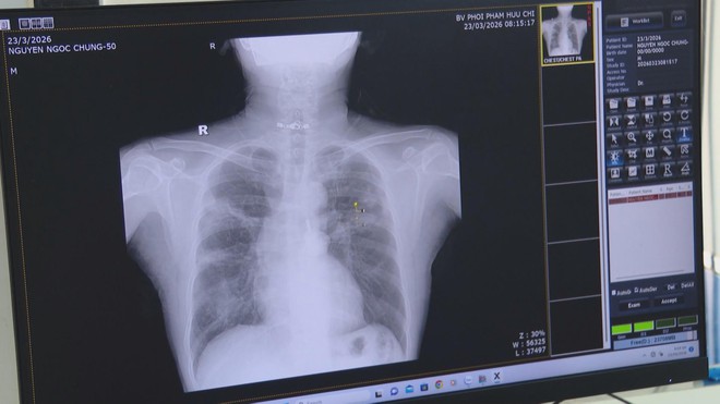 Tầm quan trọng của việc phát hiện sớm và điều trị bệnh lao kịp thời - Ảnh 1.