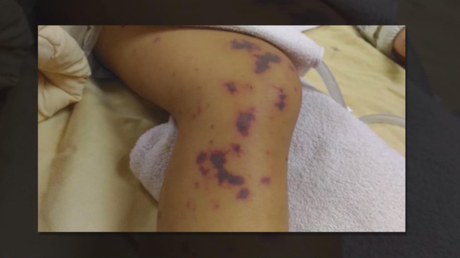 Ca mắc viêm não mô cầu gia tăng: Cần hiểu đúng về vắc-xin để phòng bệnh toàn diện - Ảnh 6.