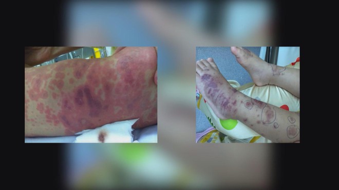 Ca mắc viêm não mô cầu gia tăng: Cần hiểu đúng về vắc-xin để phòng bệnh toàn diện - Ảnh 5.