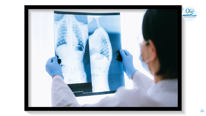 HTV Chiến thắng ung thư: Chụp X-quang, CT có gây ung thư không? - Ảnh 4.