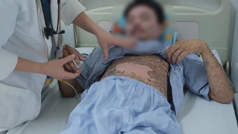 Nam thanh niên được cứu sống nhờ phát hiện sớm hội chứng hoại tử da hiếm gặp - Ảnh 1.