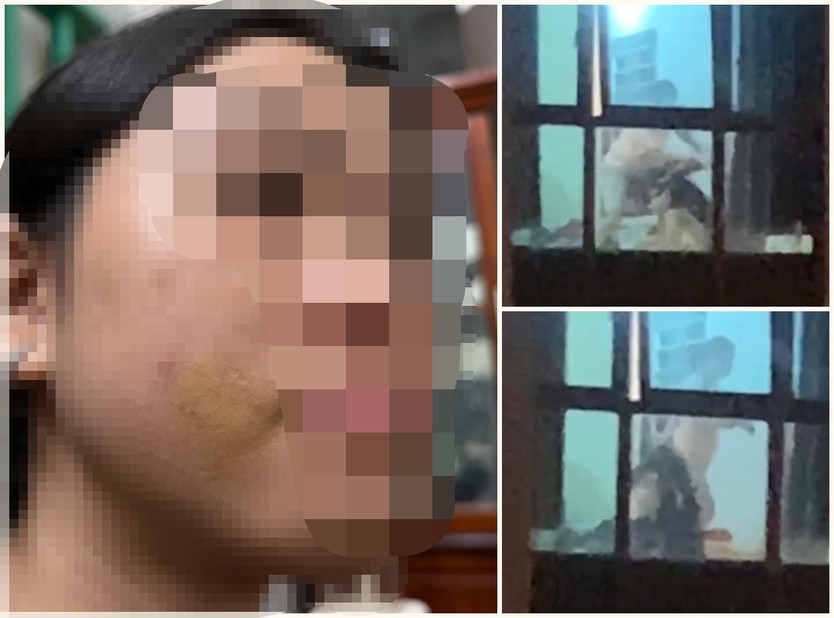 Bé gái bị mẹ kế đánh ở Phú Thọ có dấu hiệu bị bạo hành trước đó - Ảnh 2.