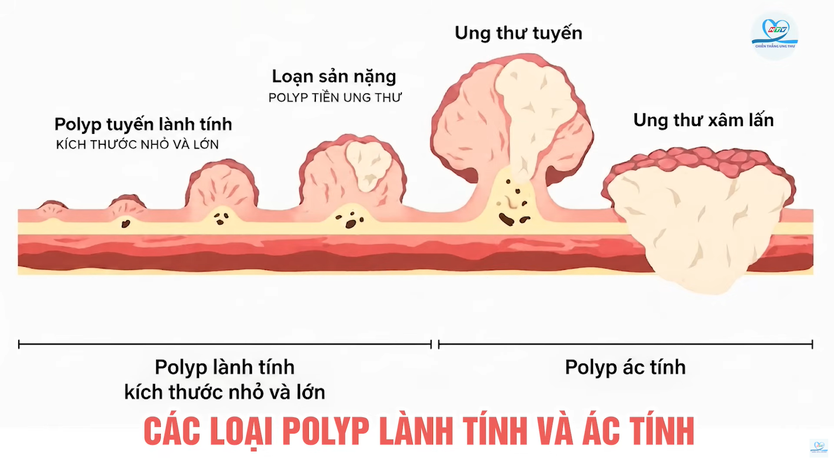 Polyp có nguy cơ thành ung thư? | HTV Chiến thắng ung thư - Ảnh 7.