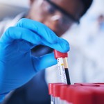 Phát triển phương pháp xét nghiệm máu dự báo nguy cơ tái phát ung thư vùng đầu - cổ