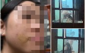 Bé gái bị mẹ kế đánh ở Phú Thọ có dấu hiệu bị bạo hành trước đó