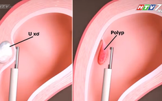Nội soi buồng tử cung: Chìa khóa nâng cao hiệu quả IVF | Tập 7 - Sống khỏe cùng chuyên gia