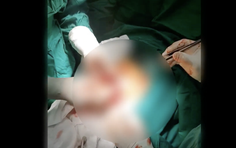 Thức khuya, ăn uống thất thường khiến chàng trai 17 tuổi thủng ổ loét môn vị tá tràng nguy kịch