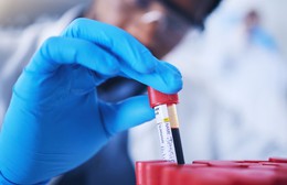 Phát triển phương pháp xét nghiệm máu dự báo nguy cơ tái phát ung thư vùng đầu - cổ