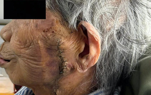 Phẫu thuật cắt bỏ khối ung thư lớn trên mặt cụ bà 99 tuổi