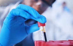 Phát triển phương pháp xét nghiệm máu dự báo nguy cơ tái phát ung thư vùng đầu - cổ