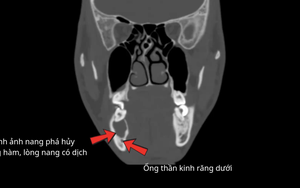 Chủ quan với răng sâu, thanh niên 25 tuổi phải cùng lúc nhổ bỏ 3 chiếc răng vì nang xương hàm