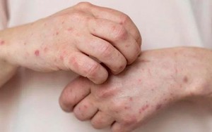 TP.HCM thêm 4 ca đậu mùa khỉ
