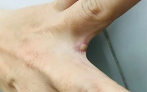 Chỉ trong 1 tuần TP.HCM ghi nhận thêm 6 ca đậu mùa khỉ