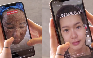 Tự peel da tại nhà - Nên hay không nên?