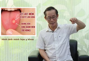 HTV Chiến thắng ung thư: Ung thư lưỡi dễ nhầm với nhiệt miệng