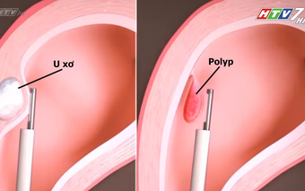 Nội soi buồng tử cung: Chìa khóa nâng cao hiệu quả IVF | Tập 7 - Sống khỏe cùng chuyên gia