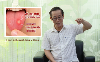 HTV Chiến thắng ung thư: Ung thư lưỡi dễ nhầm với nhiệt miệng