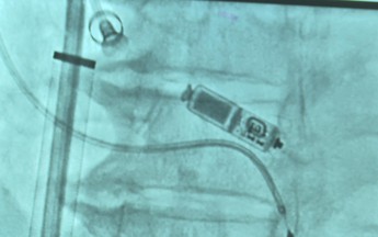 Đặt thành công máy tạo nhịp tim không dây hai buồng cứu sống cụ bà 83 tuổi