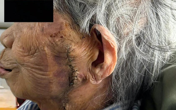Phẫu thuật cắt bỏ khối ung thư lớn trên mặt cụ bà 99 tuổi